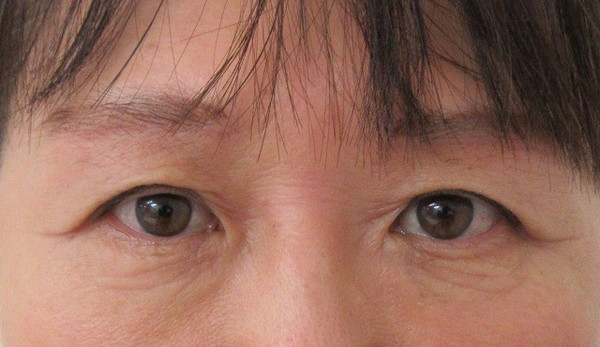 眉下切開_after写真