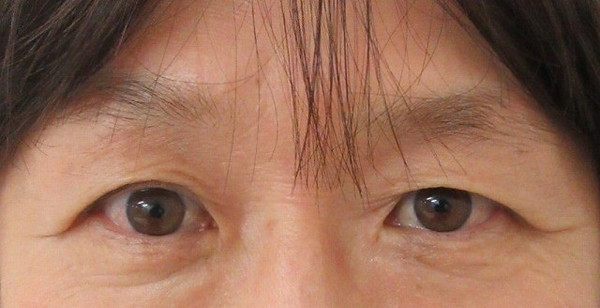 眉下切開_before写真