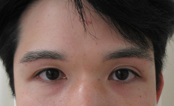 眉下切開_after写真