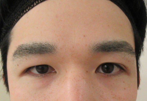 眉下切開_before写真