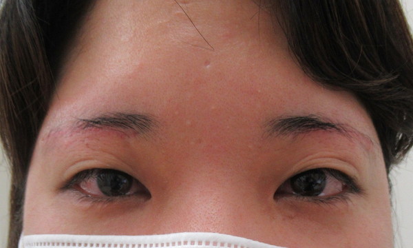 眉下切開_before写真