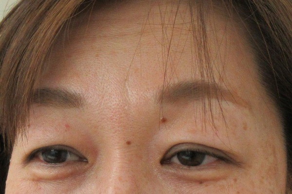 眉下切開_before写真