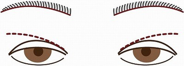 眉下切開_イメージ